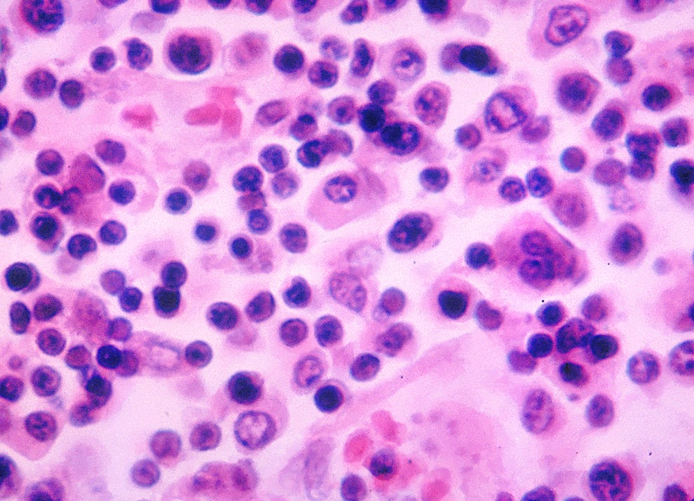 This photomicrograph reveals some of the histopathology exhibited in a lymph node tissue specimen, in a case of typhoid fever, caused by the bacterium, Salmonella typhi.